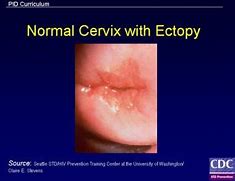 Image result for Yellow Discharge Cervical Cancer