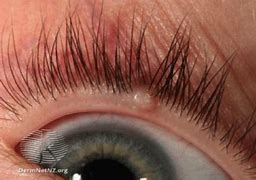 Image result for Molluscum Contagiosum Eyelid