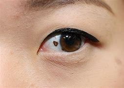 Image result for Eye Cancer Symptoms in Adults