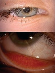 Image result for Ophthalmic Molluscum Contagiosum