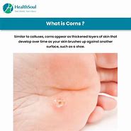 Image result for Corn Dermatology