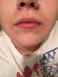 Image result for What Are Skin Rash around the Mouth