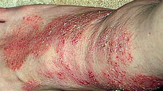 Image result for Morgellons