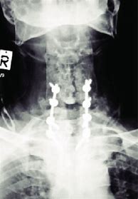 Image result for C4 C5 Spinal Fusion