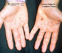 Image result for Verruca Vulgaris Common Warts