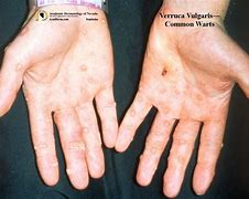 Image result for Verruca Vulgaris