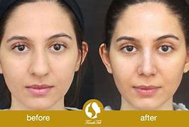 Image result for Rhinoplasty for Wide Nose