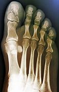 Image result for Broken Toe X-rays