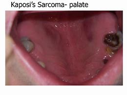 Image result for Kaposi Sarcoma Palate