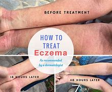 Image result for Severe Eczema Treatment