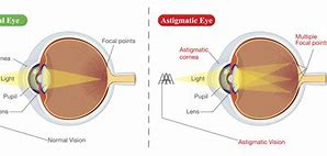 Image result for Astigmatism Eye IRL