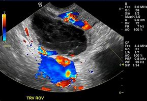 Image result for Blood Filled Ovarian Cyst