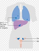 Image result for Ovarian Cancer Diagram