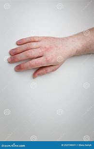 Image result for Bumpy Itchy Rash On Hands