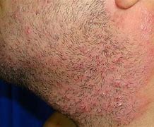 Image result for Trichomoniasis Skin