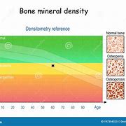 Image result for Bone Mineral Density Chart