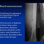 Image result for Bone Cancer Tumor