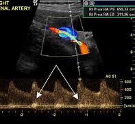 Image result for Renal Artery Bruit