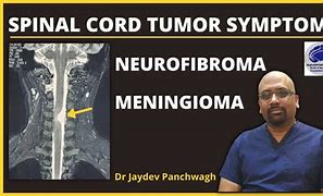 Image result for Meningioma Spinal Cord Tumor