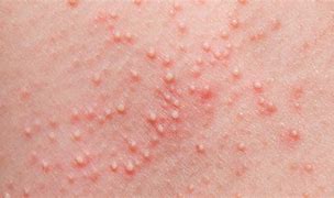 Image result for Gluten Allergy Skin Rash