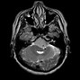 Image result for Meningioma Brain Tumors 1 Cm