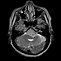 Image result for Meningioma Brain MRI