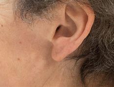 Image result for Brain with Pea Size Growth Behind Ear