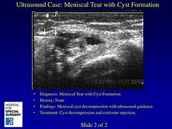 Image result for Meniscal Cyst Ultrasound