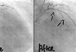 Image result for What Is a Angiogram