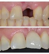 Image result for Dental Implant Bone Loss After