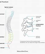 Image result for Broken Backbone Symptoms