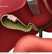 Image result for Gallbladder Cancer Gross Image