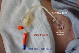 Image result for Components of a Peg Tube