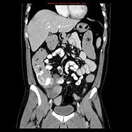 Image result for 10 Cm Tumor in Colon