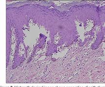 Image result for Histopathology Artifacts