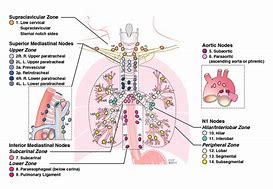 Image result for Hilar and Subcarinal Lymph Nodes