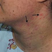 Image result for Epidermodysplasia Verruciformis