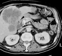 Image result for Gallbladder Cancer CT