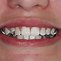 Image result for Propulseur Orthodontique