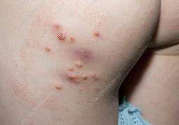 Image result for Inflamed Molluscum Contagiosum