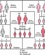 Image result for Sickle Cell Disease Genetics