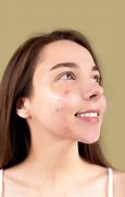 Image result for Zit Pics