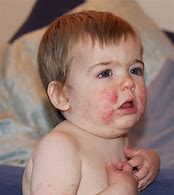 Image result for Fifths Disease Pics