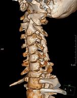 Image result for Hyperflexion of Spine in Intrauterine Death