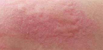Image result for Skin Cancer Symptoms Itchy Rash