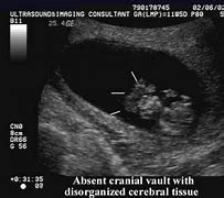 Image result for Anencephaly Sonograms