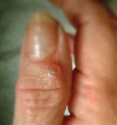 Image result for Nodules On Finger Joints Knuckles
