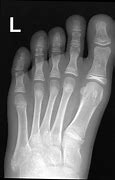 Image result for Base of 5th Metatarsal Apophysis