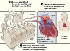 Image result for Heart-Lung Bypass Clip Art