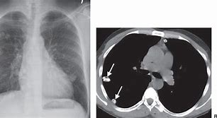 Image result for Calcified Lung Nodules Radiology
